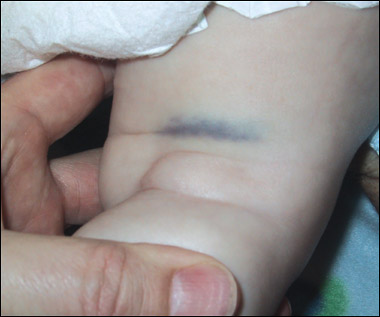 Un « bleu » chez un nourrisson de moins de 6 mois…