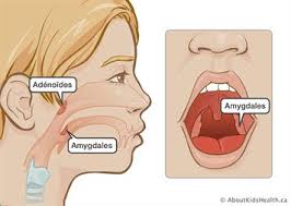 L’ablation des amygdales augmente le risque de certaines maladies